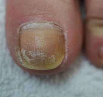 Footlogix manufacturer results photo - before treatment