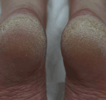 Footlogix comparison image: close-up of cracked heel skin before treatment.