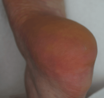 Footlogix manufacturer results photo - after treatment