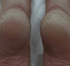 Footlogix comparison image: close-up of cracked heel skin before treatment.