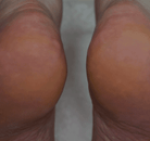 Footlogix comparison image: close-up of smoother-looking heel skin after treatment.