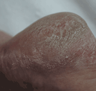 Footlogix manufacturer results photo - before treatment