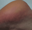Footlogix manufacturer results photo - after treatment