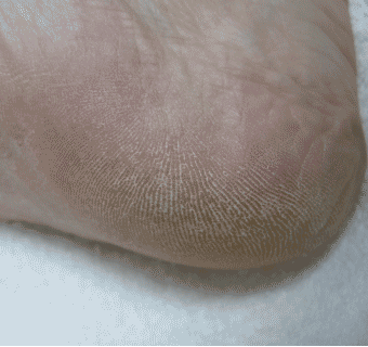 Footlogix manufacturer results photo - before treatment